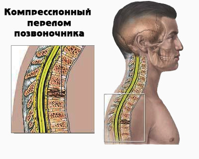 Перелом позвоночника карта вызова